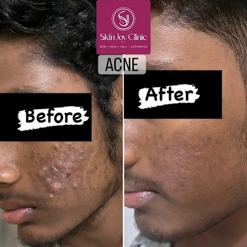 Hair Regrowth (PRP Therapy)